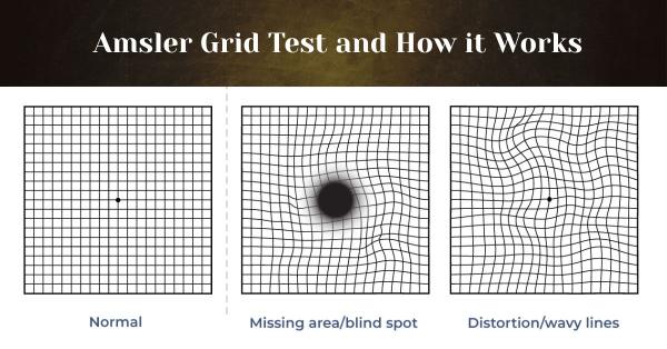 Amsler Grid Test and How it Works