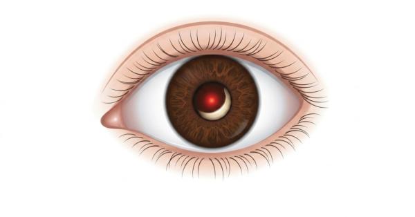 Glaucoma Testing Machines