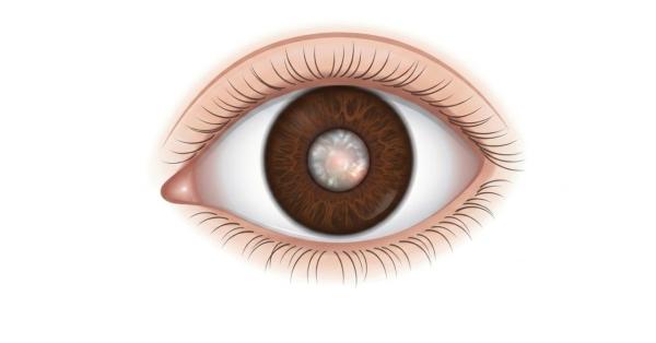 Cataract Detection Machines